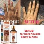 Joint Melanin Removal Serum – Lighten Black Knees & Ankles, Brighten Skin, Armpit Whitening